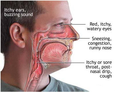 Allergy Symptoms - Sneeze, Sore Eyes, Itchy and Dry Throat