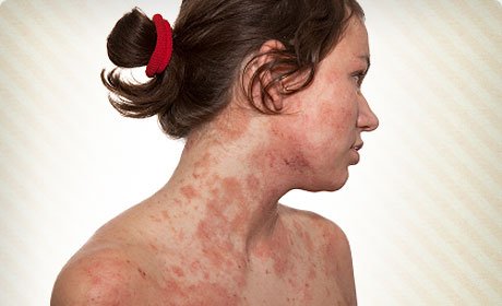 Eczema