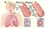 Asthmatic Adult