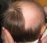 Trichotillomania - Bald patches on scalp